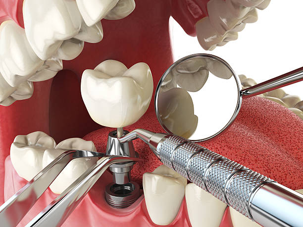 Best Emergency Root Canal Treatment in New Castle, IN
